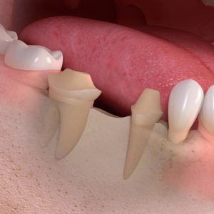 natural_teeth_bridge_case_2