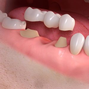 natural_teeth_bridge_case_3
