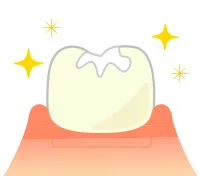 コンポジットレジン修復